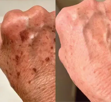 Improved skin tone and glow after VI Peel treatment