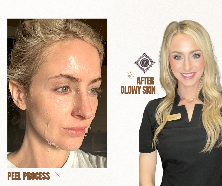 Woman experiencing facial skin peeling followed by a healthy, radiant glow after a chemical peel