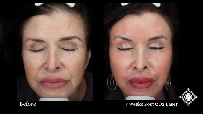 CO2 Laser Before and After