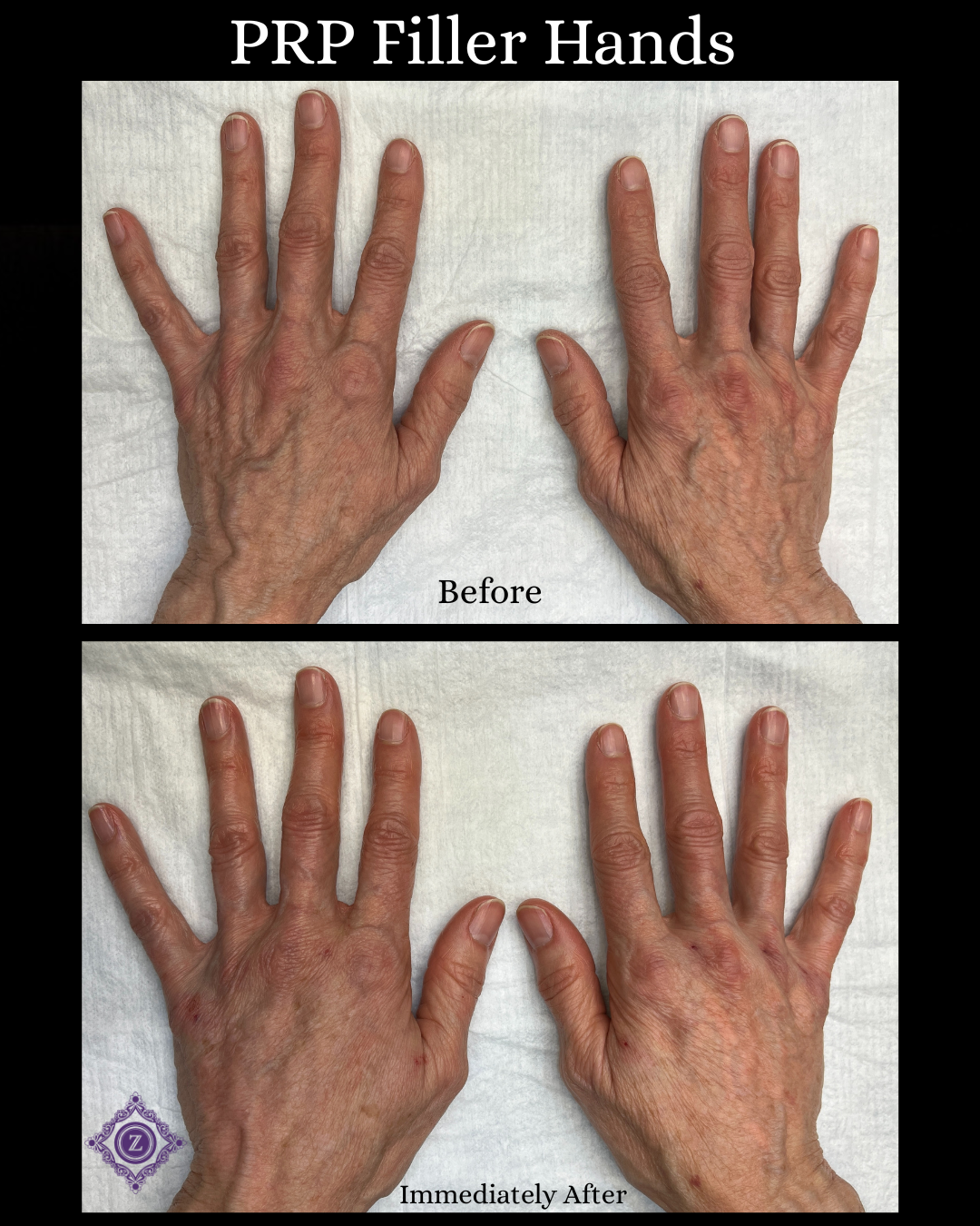 PRP Natural Filler to the hands