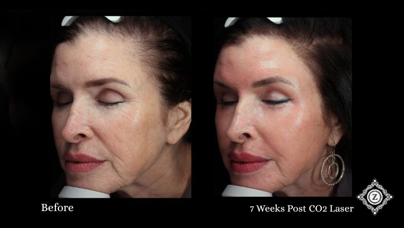 CO2 Laser Before and After