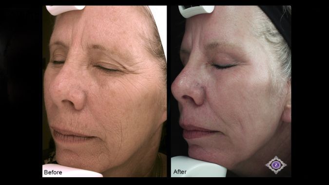 CO2 Laser Before and After