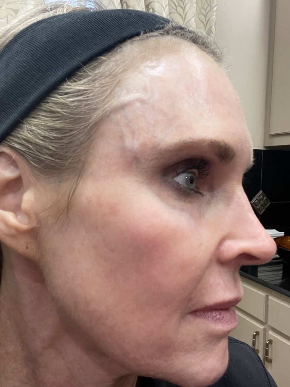 Dermal filler - After pic - Z Aesthetic Dermatology