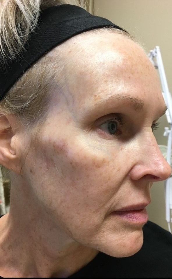 Dermal filler - Before pic - Z Aesthetic Dermatology