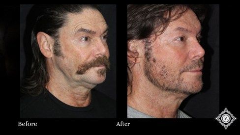 Dermal filler treatment for facial rejuvenation at Z Dermatology