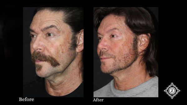 Dermal filler treatment for facial rejuvenation at Z Dermatology