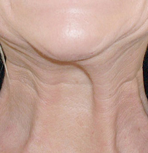 A close up of a woman 's neck with wrinkles.