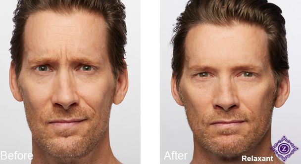 Baton Rouge Botox patient before/after receiving Botox injections from Z Dermatology.