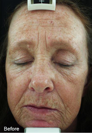 A woman 's face is shown before being measured