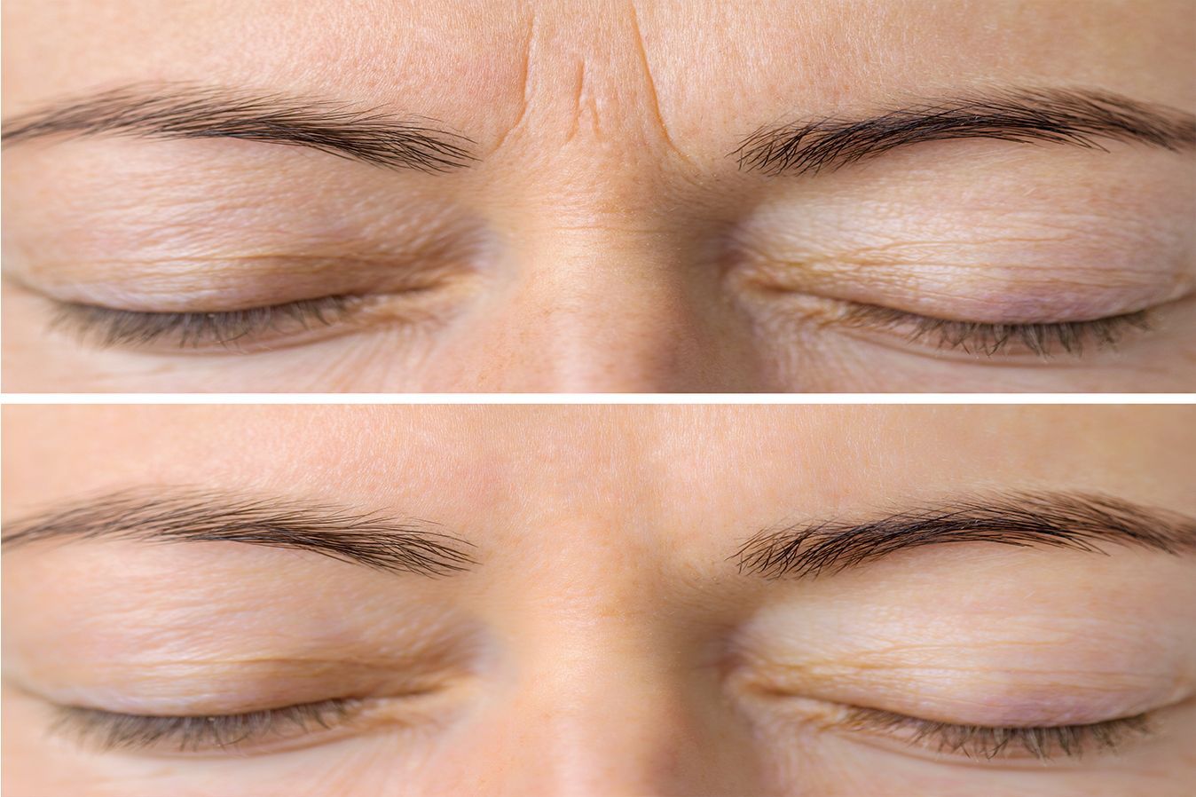 Botox before and after patient at Z Dermatology in Baton Rouge