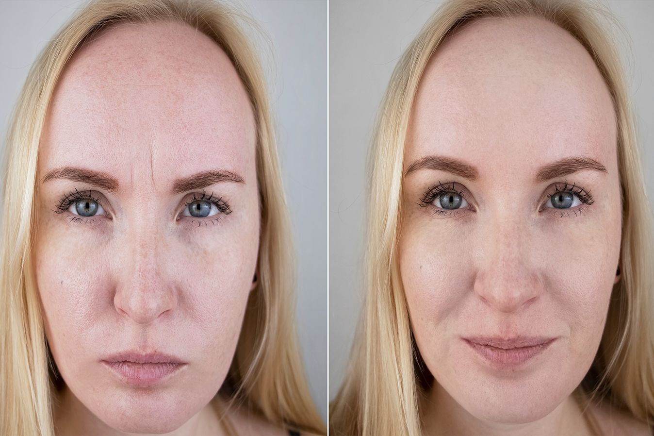 Before and after Botox for 11 lines glabellar lines at Z Aesthetic Dermatology Baton Rouge Louisiana