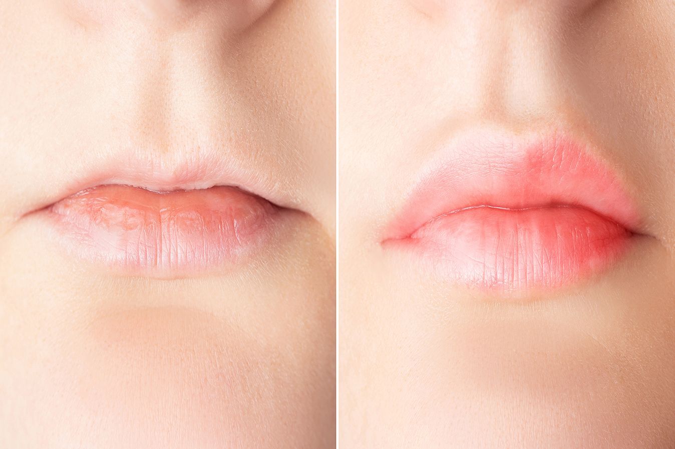 Before and After Lip Filler results at Z Dermatology in Baton Rouge
