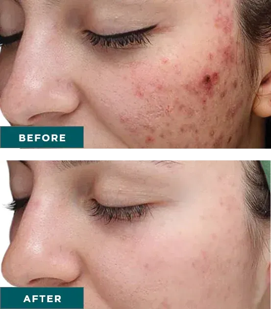 Improved skin tone and glow after VI Peel treatment
