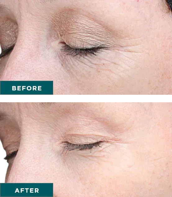 Improved skin tone and glow after VI Peel treatment