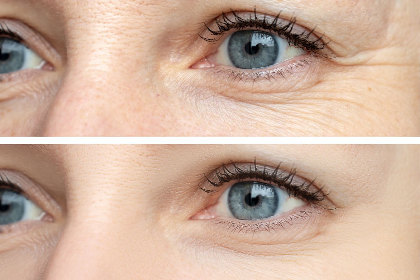 Before and After results from Neuromodulator treatment at Z Dermatology in Baton Rouge