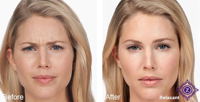 Baton Rouge Botox patient before/after receiving Botox from Z Dermatology.