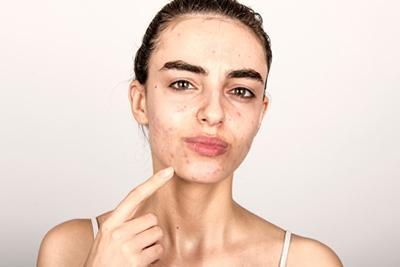 A woman with acne on her face is pointing at her face.