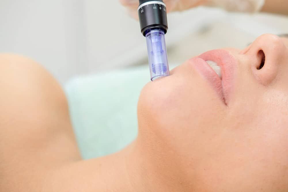 A woman is getting a microneedle treatment on her face.