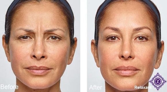 Botox before and after patient at Z Dermatology in Baton Rouge