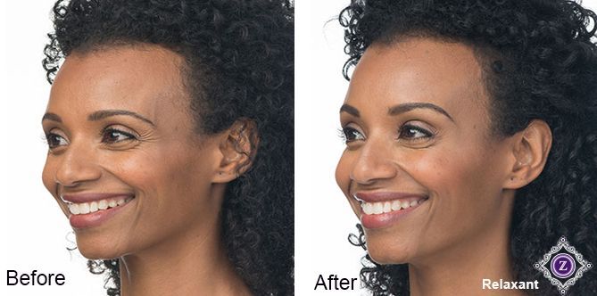 Botox Before - After Gallery