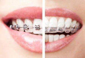 Apparecchi ortodontici