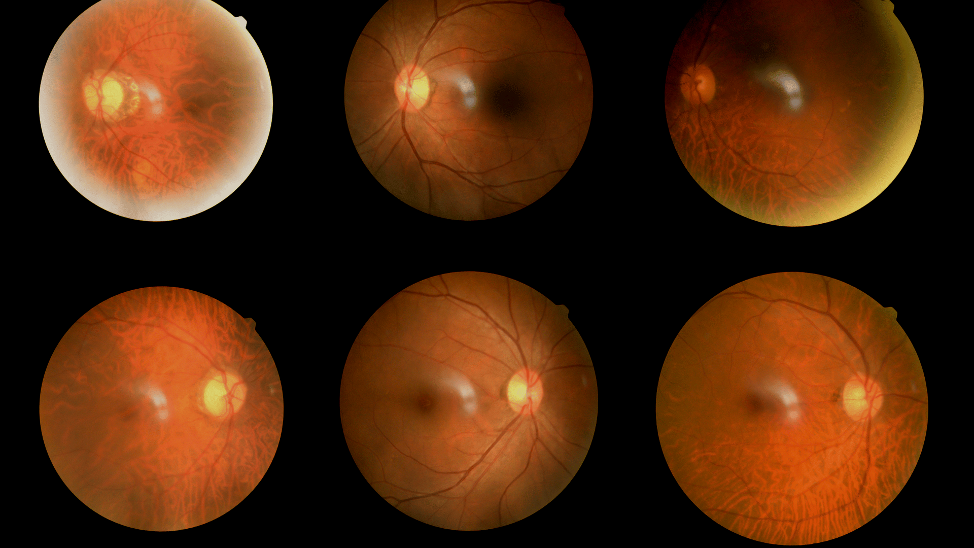Diabetic retinopathy