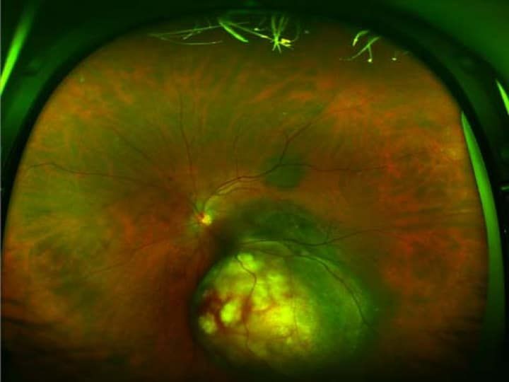 Choroidal melanoma seen on retina using Optos imaging