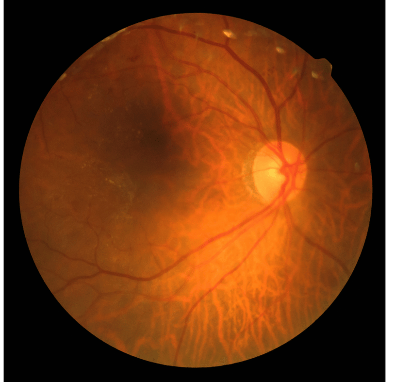 diabetic retinopathy