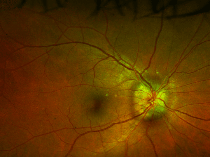 Optic nerve swelling seen on retina using Optos imaging