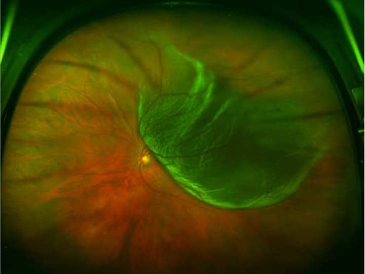 Retinal detachment seen on retina using Optos imaging