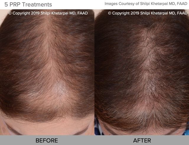 Hair Restoration Near You: Beauty LA Med Spa
