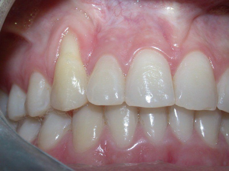 Dental restoration before 1