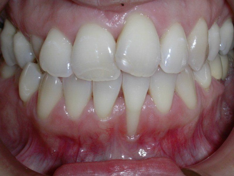Dental restoration before 1