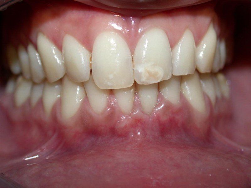 Dental restoration after 2