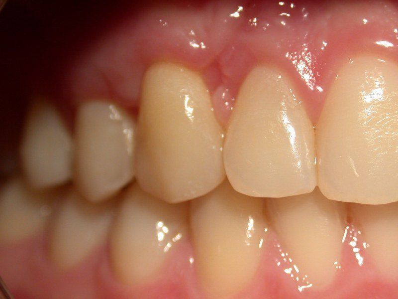 Dental restoration after 1