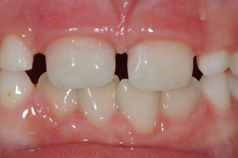 Dental restoration after