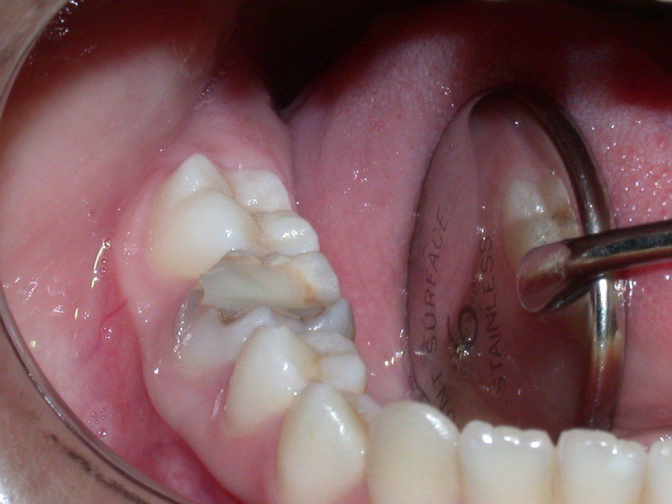 Restauro dentale prima 1