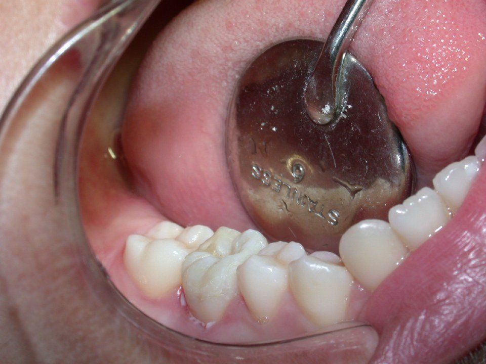 Dental restoration after 1