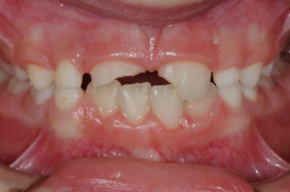 Dental restoration before