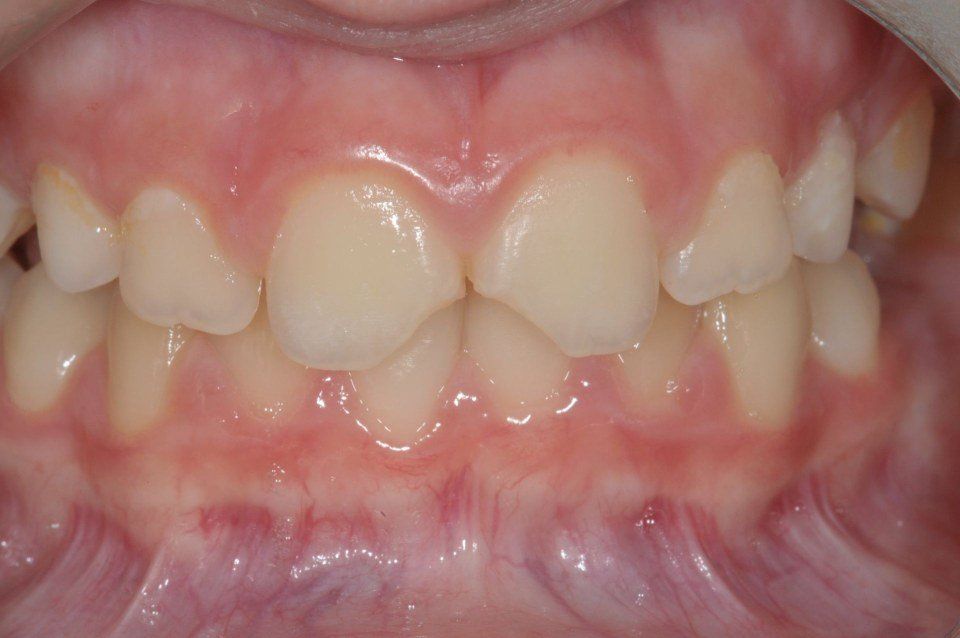 Restauro dentale prima 2
