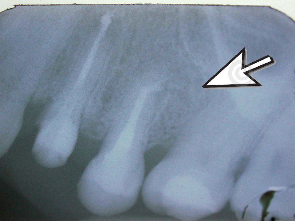 Radiografia dentale dopo