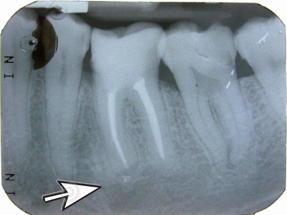 Radiografia dentale dopo 1
