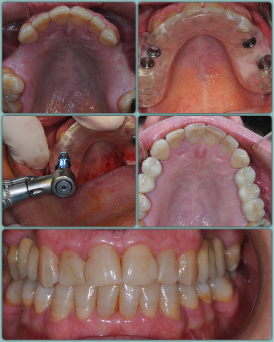 Surgical intervention on teeth
