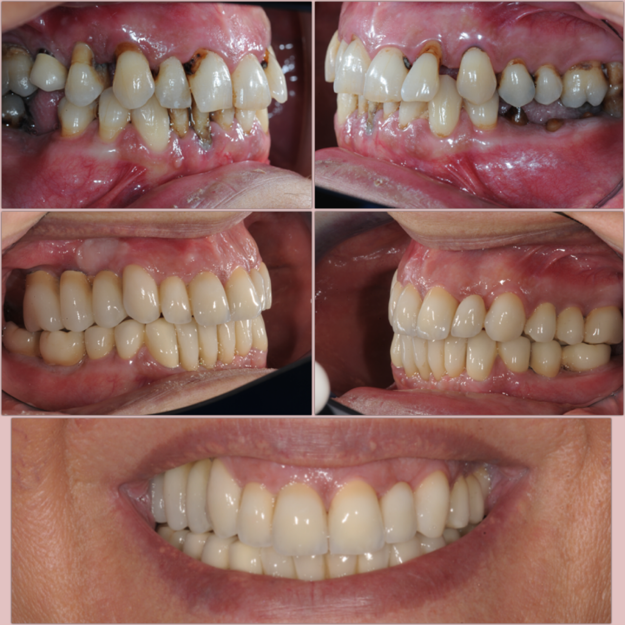 Surgical intervention on teeth