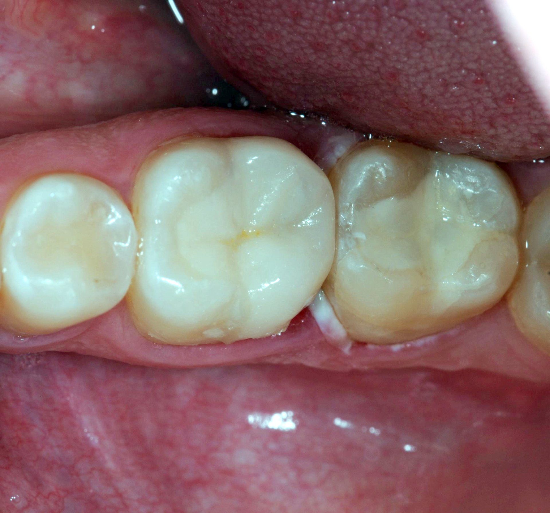 Dental restoration after 2