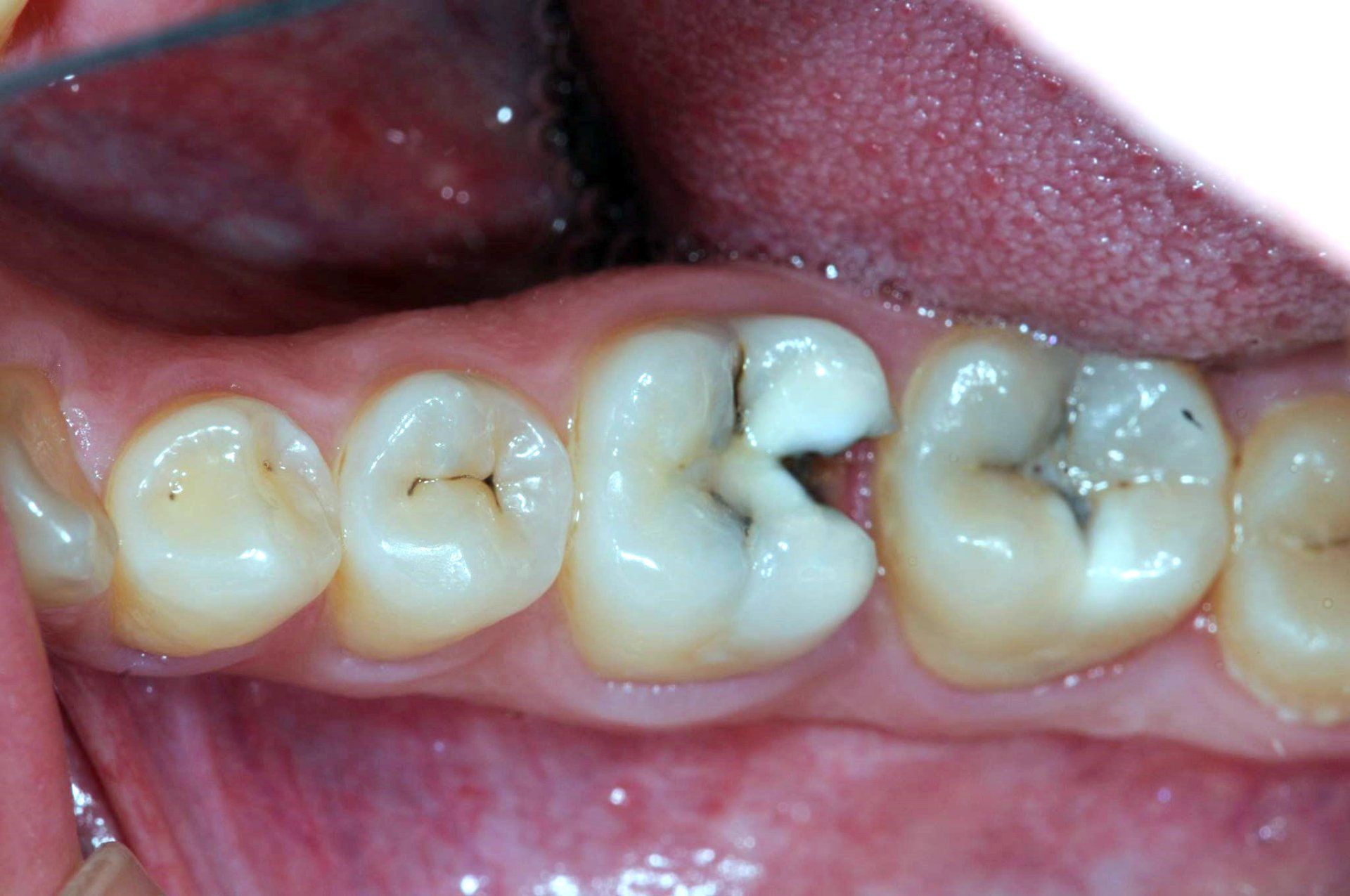 Restauro dentale prima 2