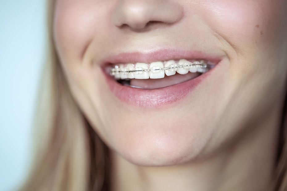 A close up of a woman 's mouth with clear braces on her teeth.