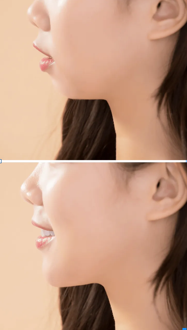 A before and after picture of a woman 's face after orthodontic surgery