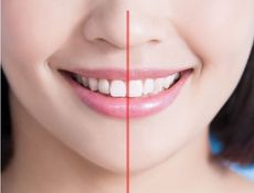 A close up of a woman 's smile showing proper teeth alignment