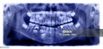 A panoramic x-ray of a child 's teeth and skull.